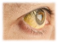 Jaundice & Biliary Diseases - Preview