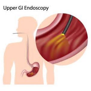 Upper GI Endoscopy (EGD) - Preview